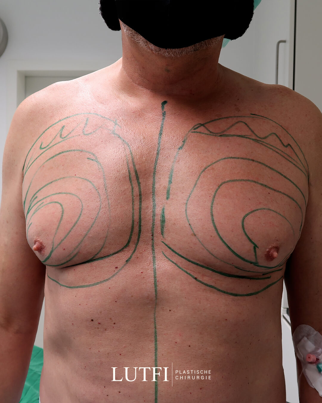 Gynecomastia before after